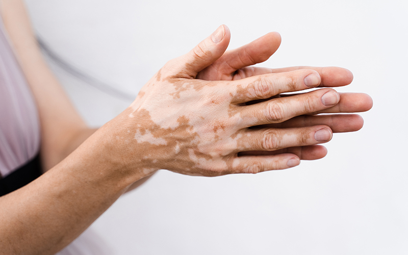 Ala Hastalığı (Vitiligo) 