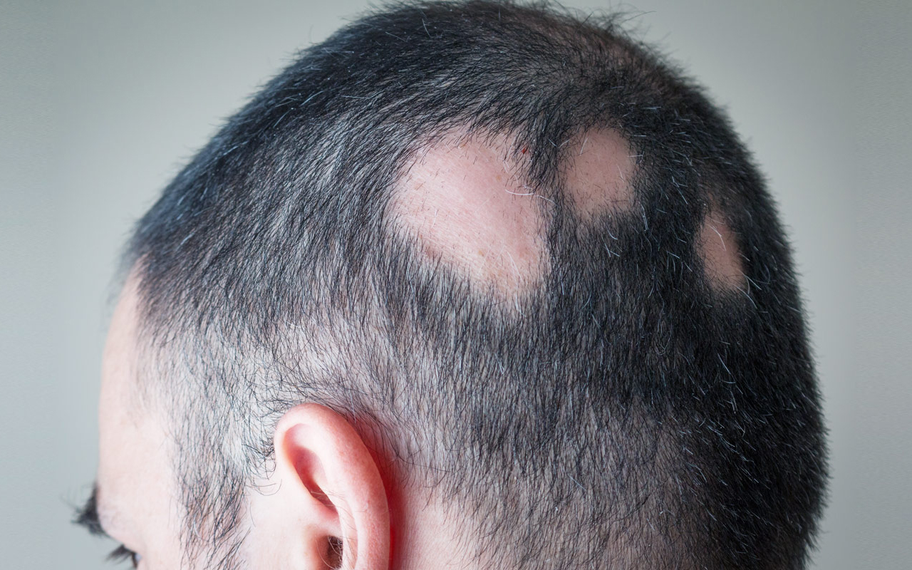 Alopesi Areata