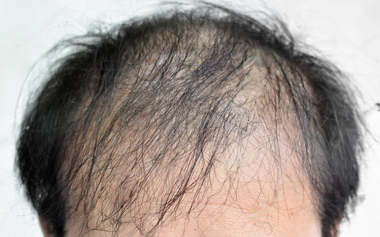 Androjenik Alopesi 