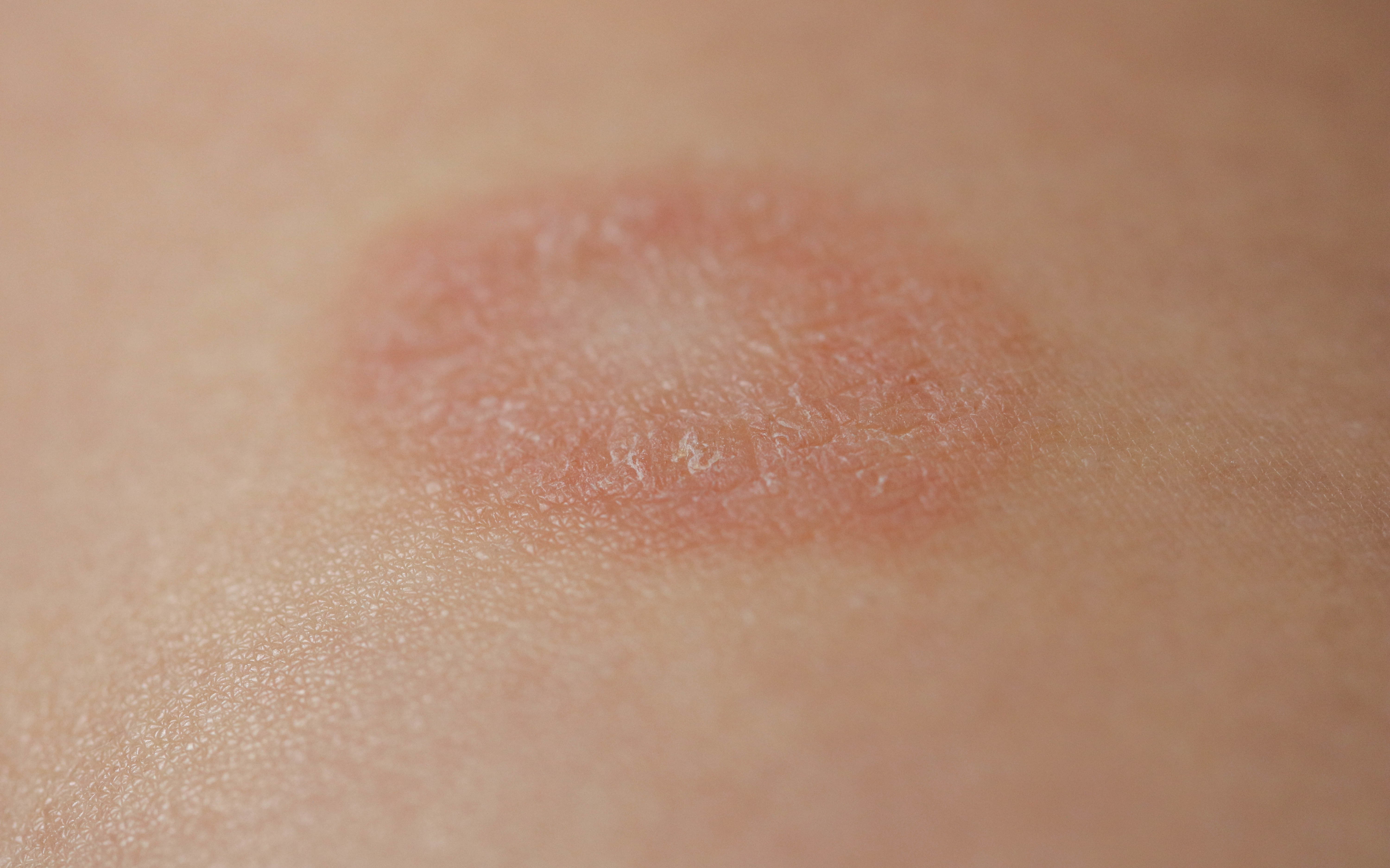 Ptriyazis Rozea 