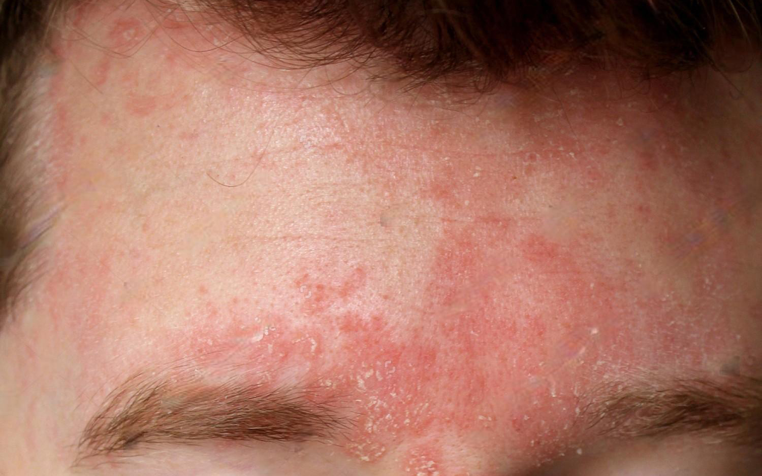 Seboreik Dermatit 